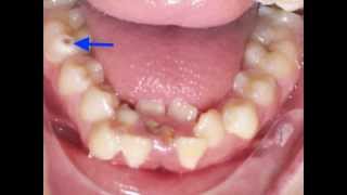 Lower Incisor Extraction Time Lapse Video Kyger Orthodontics [upl. by Chouest111]