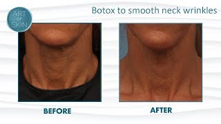 Botox To Lift Neck And Smooth Wrinkles [upl. by Liborio]