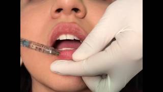 Juvederm Volbella injection to the Lips Lip Augementation [upl. by Kieran573]