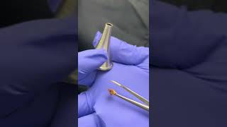 Total earwax blockage removal with microscope and forceps earwaxremoval extractionsatisfaction [upl. by Panta]