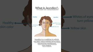 quotUnderstanding Jaundice Causes Symptoms and Treatmentquot DrAshishSachan [upl. by Denbrook744]