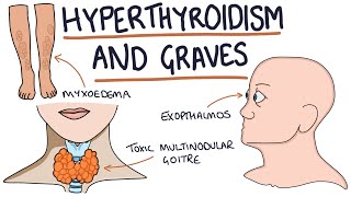 Understanding Hyperthyroidism and Graves Disease [upl. by Enaek]