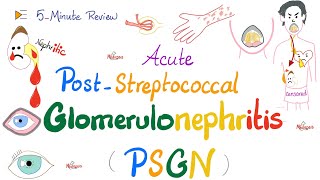 Acute PostStreptococcal Glomerulonephritis APSGN Nephritic Syndrome Kidney PathologyNephrology [upl. by Llenral]