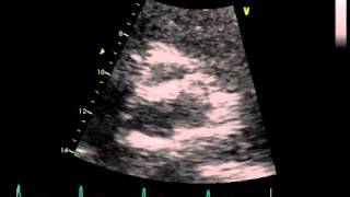 CALCIFICATION RIGHT CORONARY AORTIC CUSP [upl. by Iffar]