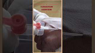 IV cannulation techniqueshots viral mbbs shortvideo ivcanula dmlt [upl. by Chew]