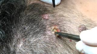 Eliminacion de Nevus Con Láser C02 [upl. by Rakel]