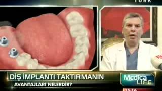 implant nedir  diş implantı taktırmanın avantajları nelerdir  Tanfer Klinik [upl. by Ainitsirc]