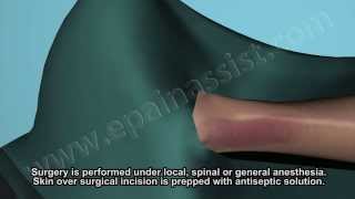 Ankle Fracture Surgery Watch How Fractured Ankle Is Treated Surgically [upl. by Onitselec]