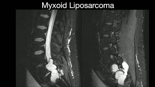 Myxoid Liposarcoma [upl. by Almat]