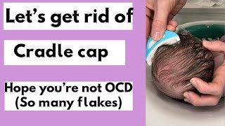 Cradle cap how to remove flakes using Frida Baby remover [upl. by Llerrej]