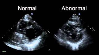 Echocardiogram from the Patient Compared with That from a Normal Control  NEJM [upl. by Ramirol]