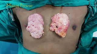 GYNAECOMASTIA IN BODYBUILDERS BY DR MANOJ PAWAR PLASTIC COSMETIC AND RECONSTRUCTIVE SURGEON PUNE [upl. by Aihsekram]