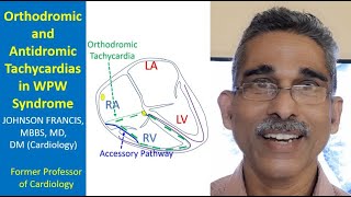 Orthodromic and Antidromic Tachycardias in WPW Syndrome [upl. by Nytnerb525]