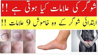 Diabetes and Its Common Symptoms Sugar Ki Alamat Kya Hoti Hai  Dr Kashif Ali [upl. by Annovaj]