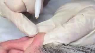 Electrolysis Treatment On Tragus and Ears [upl. by Ettenom269]