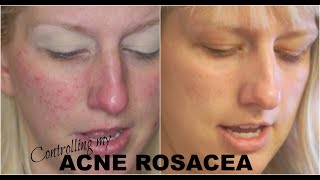 Acne Rosacea Skincare What Finally Worked Dermalogica Update 3 [upl. by Ralyat]