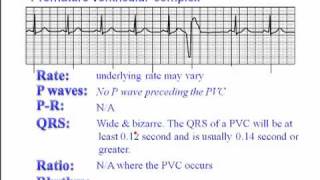 ECG Premature Ventricular Complexes PVC [upl. by Jaal]