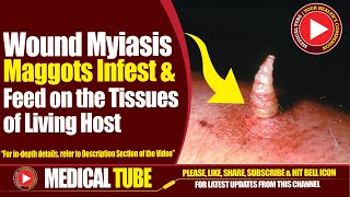 Wound Myiasis  Causes Symptoms Diagnosis And Treatment  Medical Tube [upl. by Euqinorev599]