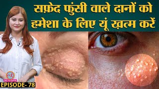 Milia यानी Skin पर सफ़ेद फुंसी वाले Pimples को आसानी से खत्म करने का तरीका  Sehat ep 78 [upl. by Stuckey]