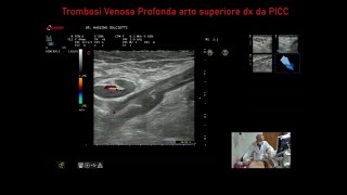 Trombosi Venosa Profonda da PICC al braccio destro [upl. by Chappie]