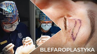 Blefaroplastyka  Plastyka powiek górnych i dolnych Bieńkowscy Clinic® [upl. by Hobie946]