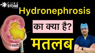 Hydronephrosis क्या होता है  Kidney की सूज़न  Hydronephrosis RIRS  Kidney Stone Treatment [upl. by Acirretahs380]