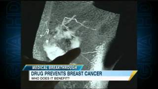 Aromasin New Drug May Help Prevent Breast Cancer [upl. by Ahsaz754]