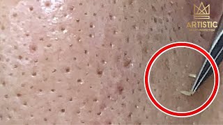 กดสิว blackheads filaments on nose remove with tweezers [upl. by Marb887]