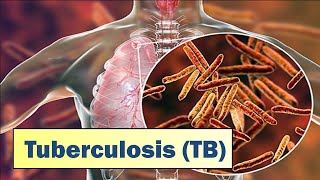 Tuberculosis TB I Causes Symptoms Prevention amp Treatment [upl. by Svend]