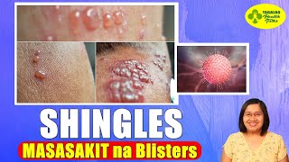 MASAKIT na Blisters Dulot ng SHINGLES  Varicella Zoster Virus  Tagalog Health Tips  Nurse Dianne [upl. by Barsky]