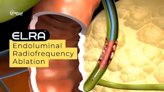 Endoluminal Radiofrequency Ablation ELRA  Percutaneous Approach [upl. by Pedaias303]