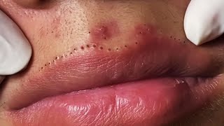 Lips Blackhead removal Video 53 Blackheads blackheadsremoval sebum [upl. by Llewop853]