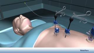 Colecistectomía Laparoscópica con el Sistema Weck® Hemolock® Auto Endo 5® [upl. by Larentia]