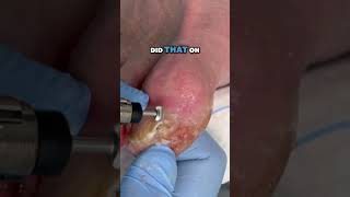 I put the finishing touches on this patients toenail Click the link to watch the full video [upl. by Clerk]