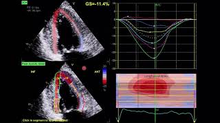 Echocardiographic features of cardiac amyloidosis  2 D echo  Strain GLS  cherry on top pattern [upl. by Acinehs642]