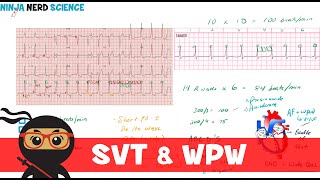 Rate and Rhythm  Supraventricular Tachycardia SVT and WolffParkinsonWhite WPW Syndrome [upl. by Bumgardner]