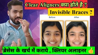 What is Clear Aligner  Time amp Cost  Aligners क्या होते है  समय और इनका खर्च [upl. by Senecal383]