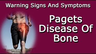 Warning Signs And Symptoms Of Pagets Disease Of Bone [upl. by Lindsley]