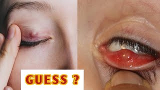 Stye or chalazion  explained indetail eyecareoptom eyelid infection lidproblems [upl. by Spoor]