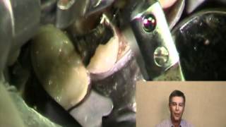 Root Canal Procedure [upl. by Reffotsirhc240]