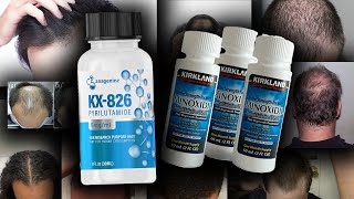 New Pyrilutamide KX826  Minoxidil Clinical Trial Will KX826 work [upl. by Courtland]