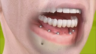 Straumann  Fixed restoration with 46 implants all straight [upl. by Myk44]