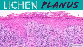 Lichen Planus amp Hypertrophic Lichen Planus Inflammatory Dermpath 101 for Dermatology amp Pathology [upl. by Kati768]