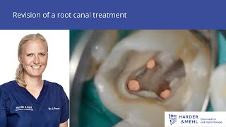 Revision of a root canal treatment [upl. by Oinafipe532]