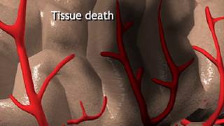 How Stroke Happens Animation  How Strokes Affect the Brain Video [upl. by Casanova]