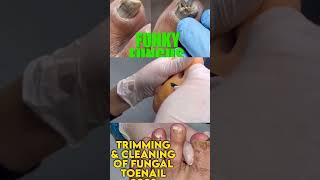 Part 2 Best of Callus Treatments Podiatry  Fungal Nail with Dried Abscess 🦶 Ingrown Nail Treatment [upl. by Bertram]