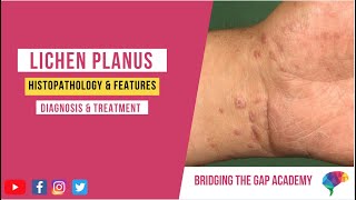 What is Lichen Planus Histopathology amp Features Diagnosis amp Treatment [upl. by Ybrek]