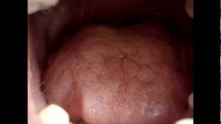 Tongue Fasciculation Motor Neuron Disease Osama SM Amin FACP amp Saad S Shwani MD [upl. by Old928]