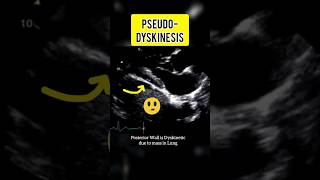 Pseudo Dyskinesia shorts trending echocardiography heartdisease cardiology [upl. by Chavez]