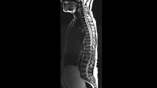 Hypointense vertebrae on T1 and T2 Marrow infiltration DD Lymphoma Multiple myeloma metastasis [upl. by Sarilda723]